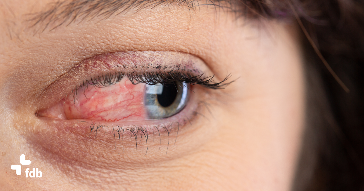 Rimedi naturali per le allergie oculari