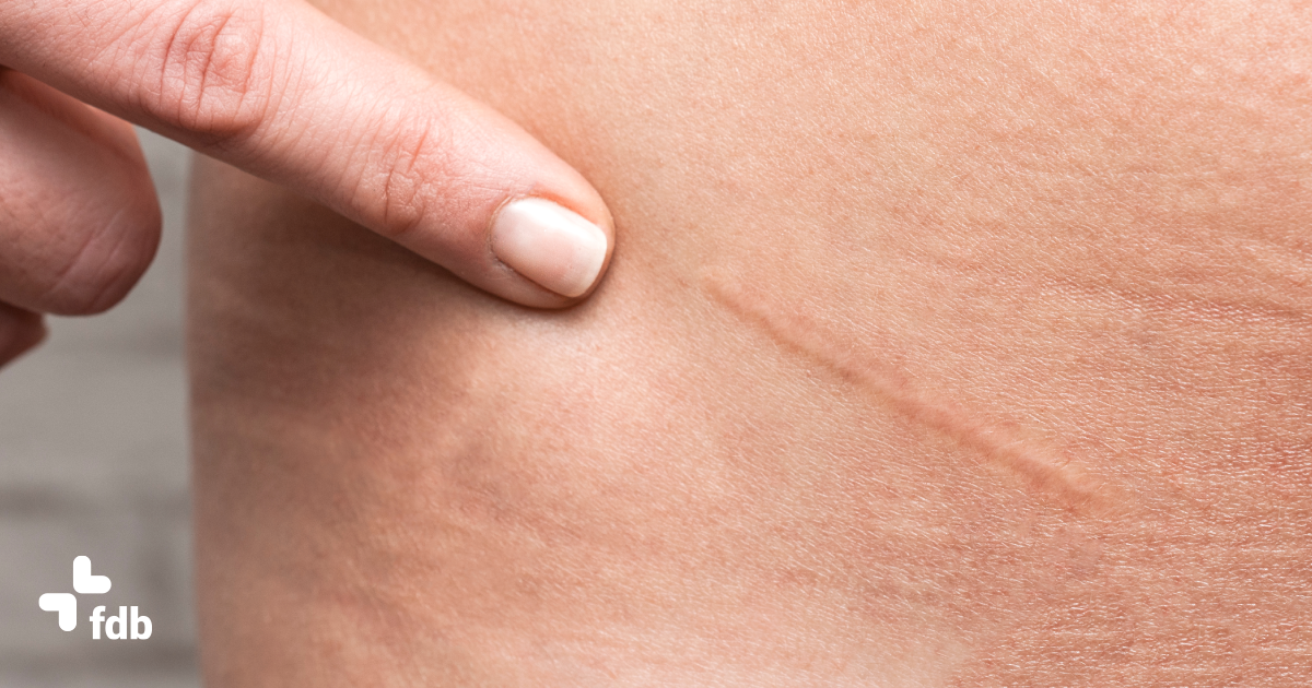 Come migliorare l’aspetto delle cicatrici