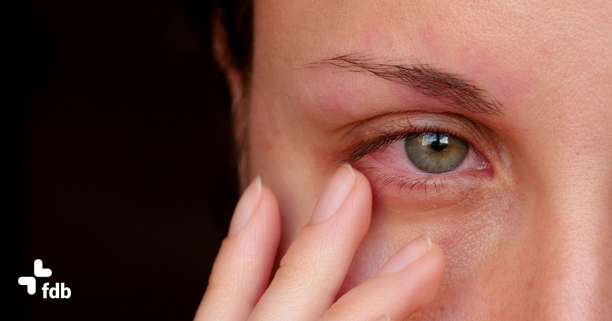 Cause e rimedi per gli occhi rossi