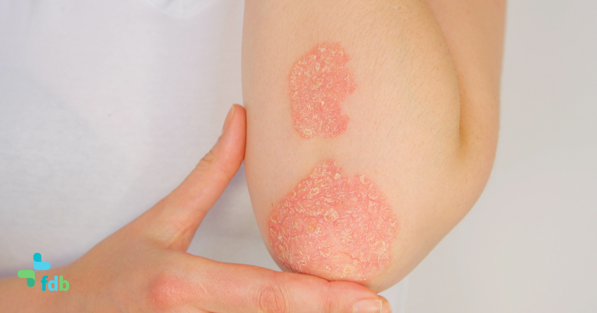 Che cos'è la psoriasi e come si cura