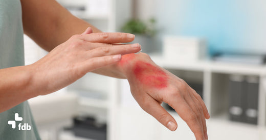 ragazza applica una crema su un'ustione alla mano procurata tra le mura domestiche