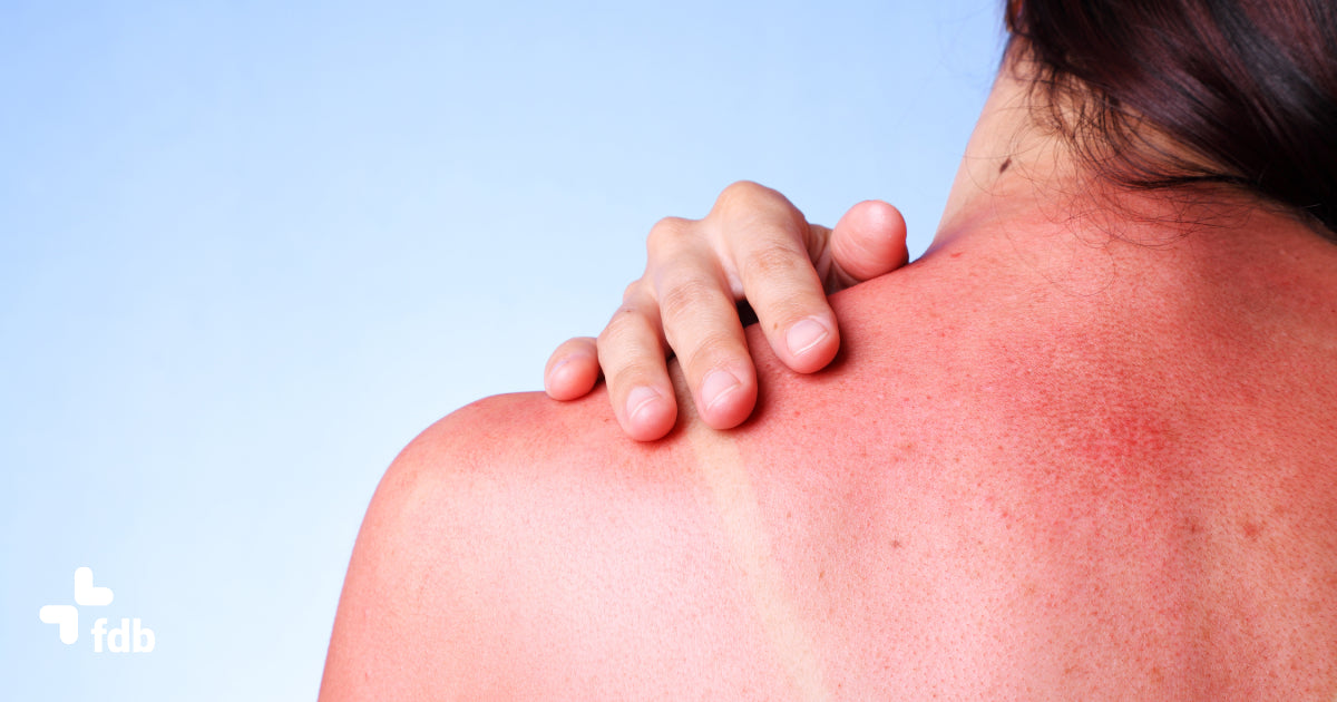 Donna soffre di eritema solare
