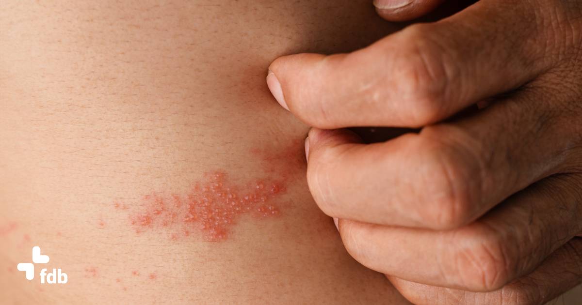 Fuoco di Sant'Antonio: cause e trattamento | Farmacia di Bettolle