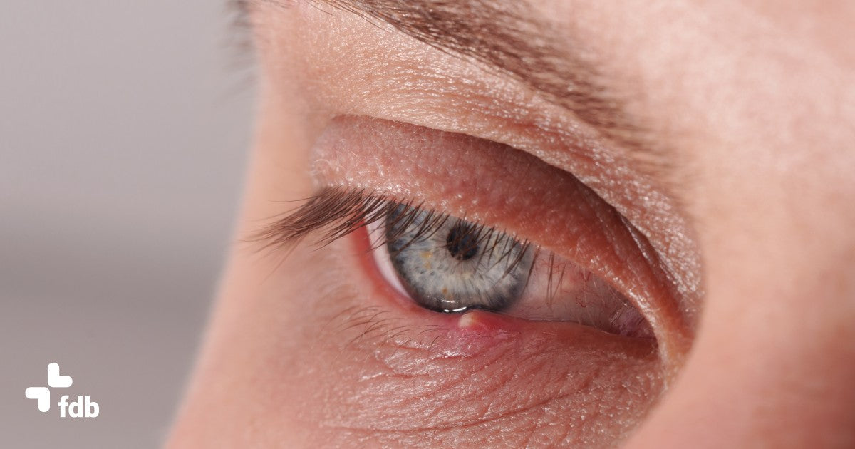 Cosa fare quando si ha un orzaiolo e come trattarlo