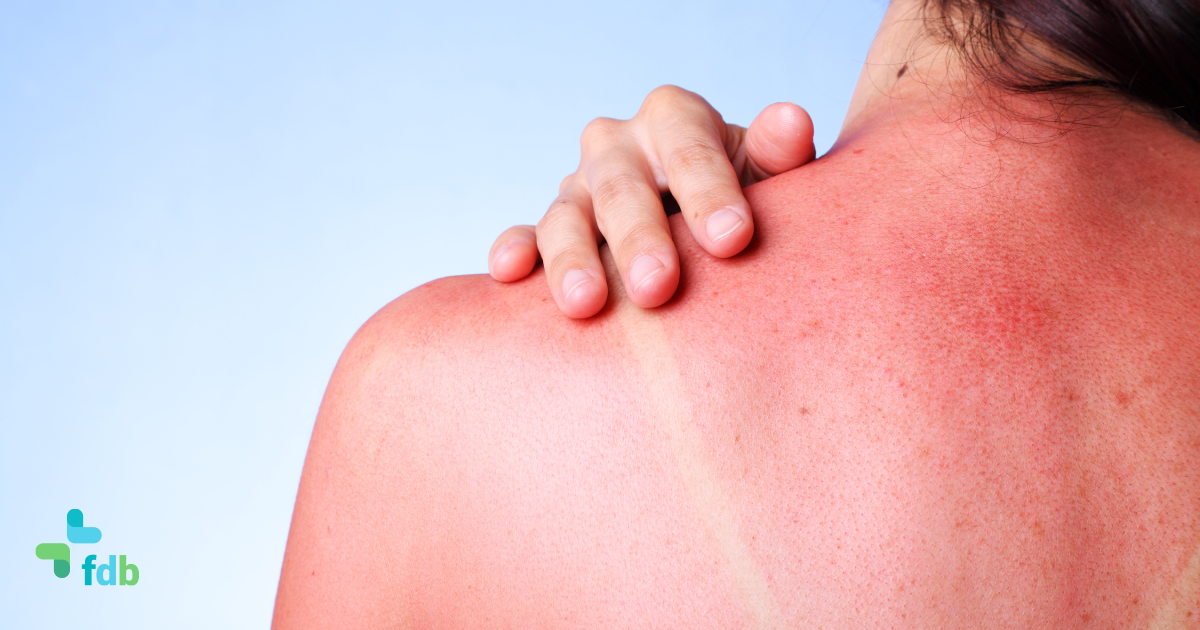 Scottature solari: ecco cosa fare