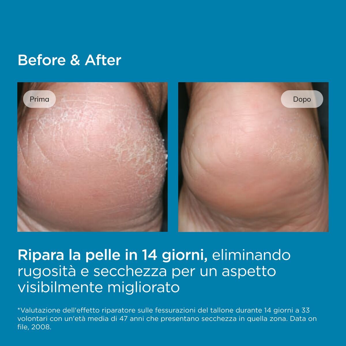 ISDIN Ureadin Podos Gel Olio Idratante Per Fissurazioni e Ispessimenti Tallone e Pianta del Piede 100 ml